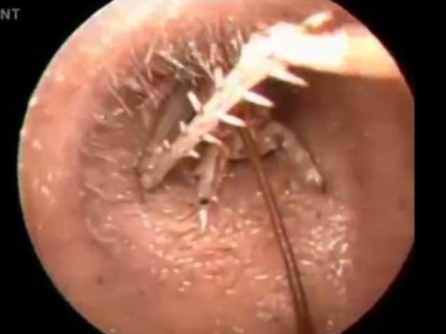 Шокирующие истории людей, внутри которых были найдены отвратительные насекомые насекомые внутри людей, существа внутри людей, личинки в телах людей