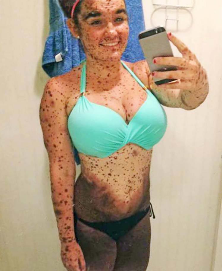 Девушка с сотнями родинок и родимых пятен одела бикини, чтобы доказать хулиганам, что ей нечего стесняться Сьера Суоринген, Ciera Swaringen, сотни родинок по всему телу, сотни родимых пятен по всему телу, врожденные меланоцитарные невусы