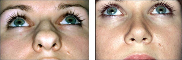 Чудеса ринопластики: удивительно, как сильно пластика носа может изменить внешность человека ринопластика до и после, пластика носа до и после, сравнительные фотографии ринопластика, сравнительные фотографии пластика носа