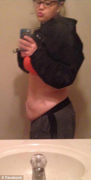 Победное похудение 19-летней девушки на 95 кг, оставившее её с обвисшей кожей девушка похудела на 95 кг, похудела осталась лишняя кожа, после похудения осталась лишняя кожа, Кейтлин Смит