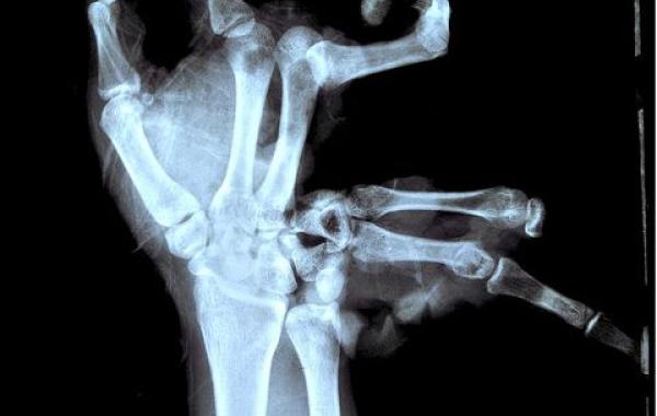 Шокирующие рентгеновские снимки людей, на которых можно увидеть всё, что угодно