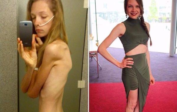 до и после анорексии, люди которые смогли победить анорексию