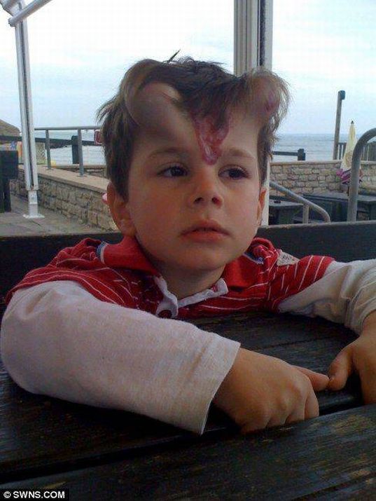 Ребенку, сделали ,операция, удаление, пятна