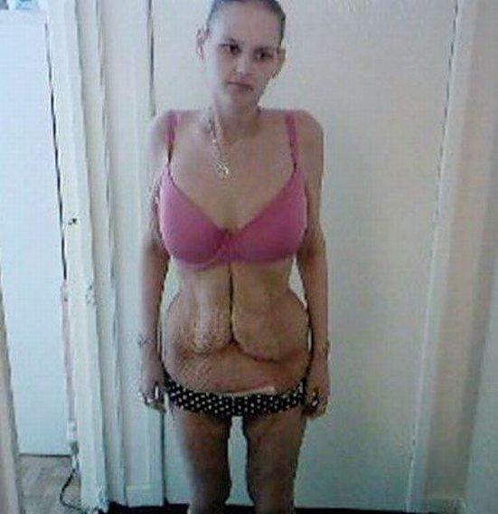 Толстая девушка похудела и заболела анорексией