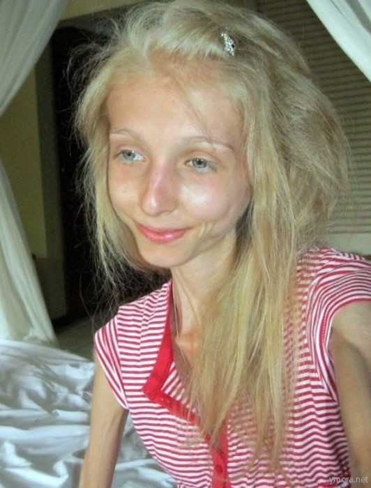 Последняя диета или анорексия