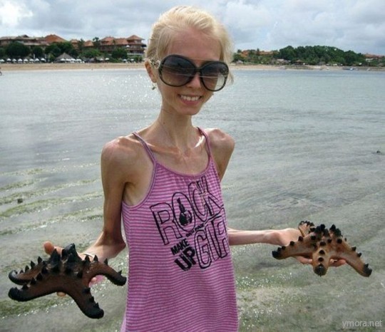 Последняя диета или анорексия