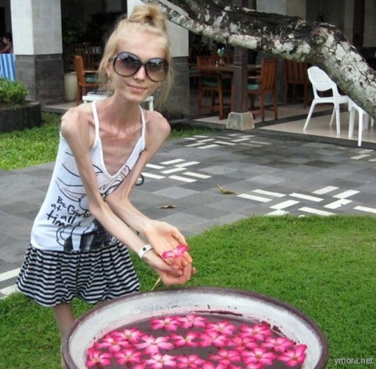 Последняя диета или анорексия