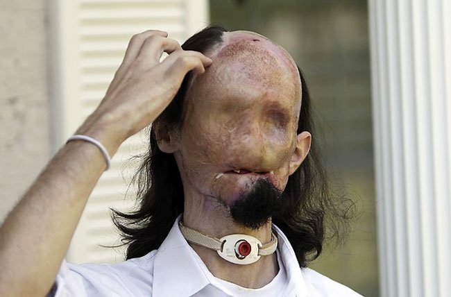 Человек без лица обрёл вторую жизнь