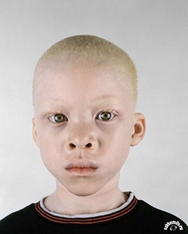 Тяжёлая жизнь африканских негров-альбиносов.