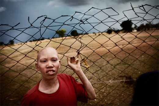 Тяжёлая жизнь африканских негров-альбиносов Тяжёлая жизнь африканских негров-альбиносов