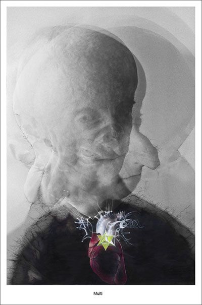 DJ Leon Botha и его страшная болезнь DJ Leon Botha и его страшная болезнь, прогерия