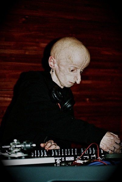 DJ Leon Botha и его страшная болезнь DJ Leon Botha и его страшная болезнь, прогерия