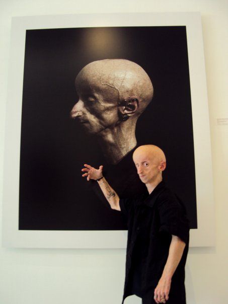 DJ Leon Botha и его страшная болезнь DJ Leon Botha и его страшная болезнь, прогерия