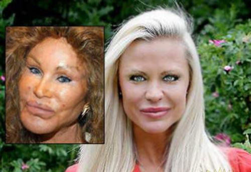  Джоселин Вайлд - жертва пластической хирургии