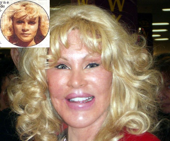  Джоселин Вайлд - жертва пластической хирургии