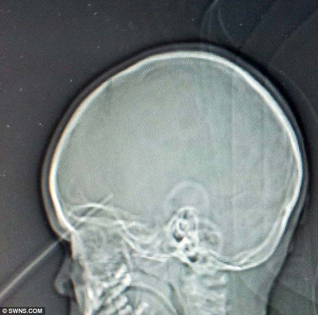 Девочка была на один миллиметр от смерти