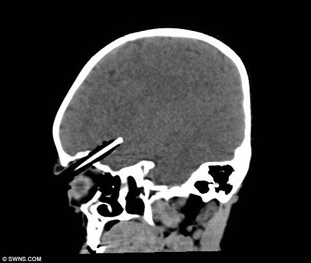 Девочка была на один миллиметр от смерти
