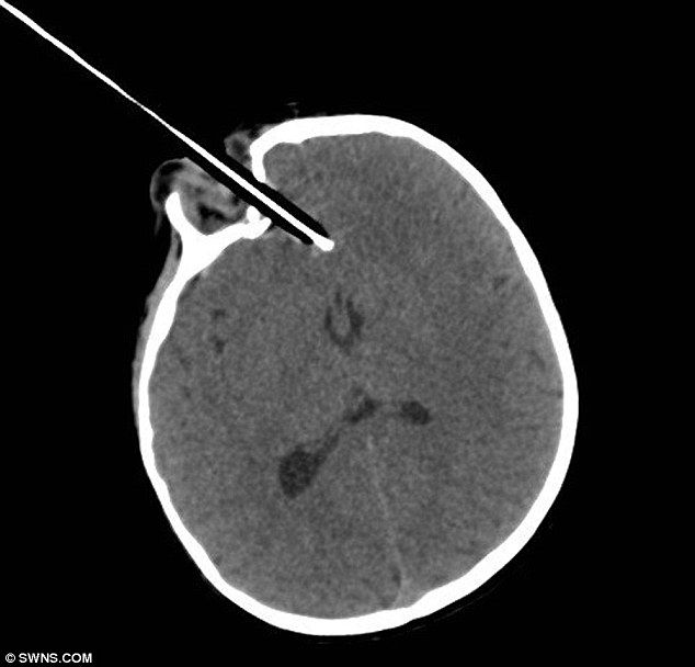 Девочка была на один миллиметр от смерти