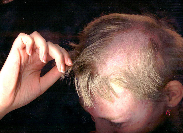 Трихотилломания, болезнь, Ребекка Браун, выдёргивать волосы, rebecca brown trichotillomania