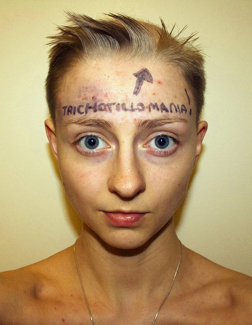 Трихотилломания, болезнь, Ребекка Браун, выдёргивать волосы, rebecca brown trichotillomania