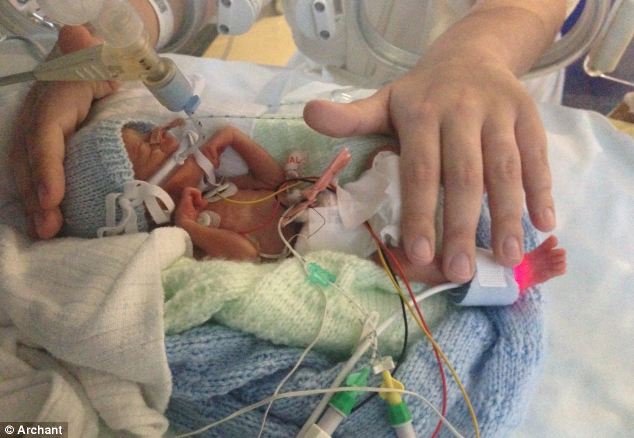 Борьба за жизнь недоношенного малыша весом меньше 500 гр. Недоношенный ребенок, малыш, маленький ,вес, Итан, неонатальное оборудование