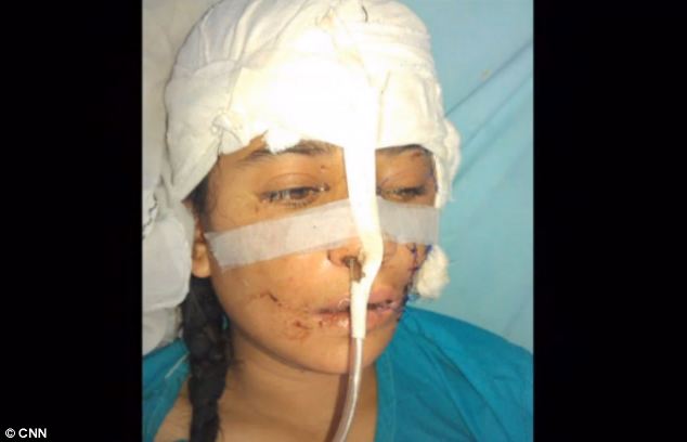 Жизнь после 15 ударов топором Девушка, шрамы, 15 ударов топором, Гюль,Пакистан, афганистан