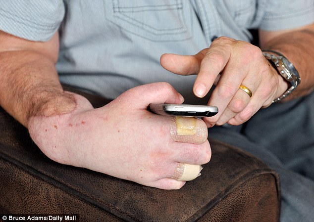 Пересадка руки, в Великобритании ,Марк Кэхилл