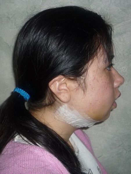 Софи Йейтс, новое лицо, пластическая, ортогнатическая, хирургия