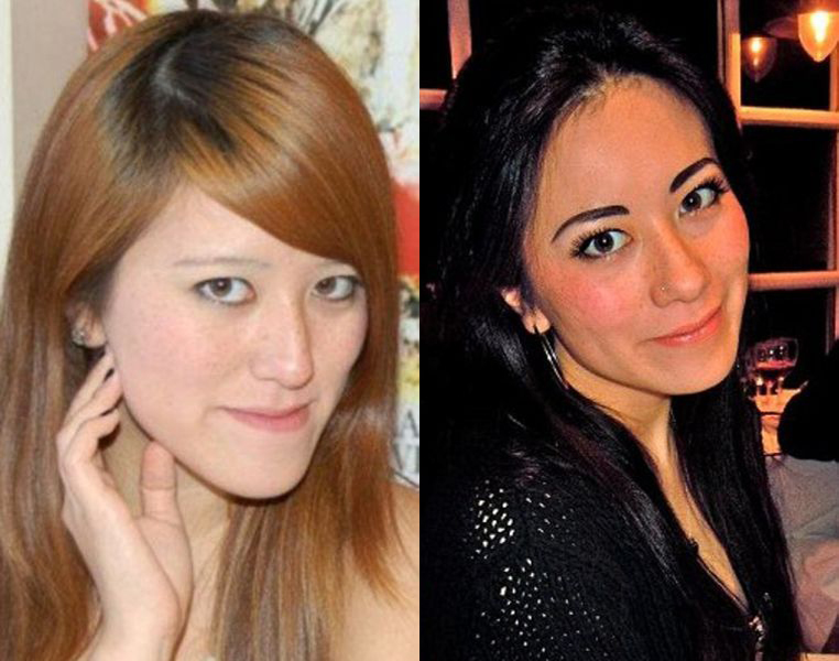 Софи Йейтс, новое лицо, пластическая, ортогнатическая, хирургия