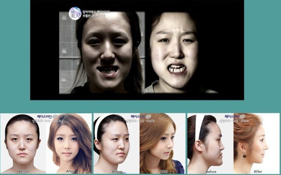 Жутковатые близняшки из Кореи до и после пластической операции близняшки, корея, до и после, пластическая операция