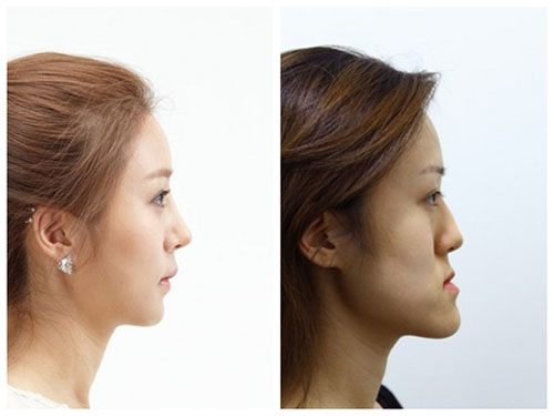 Жутковатые близняшки из Кореи до и после пластической операции близняшки, корея, до и после, пластическая операция