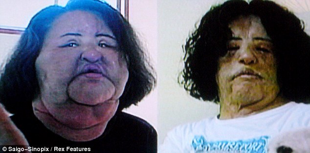 Жесть, шок, пластические операции, медицина, Ханг Миоку, корейская певица, инъекции силикона, девушка из Кореи