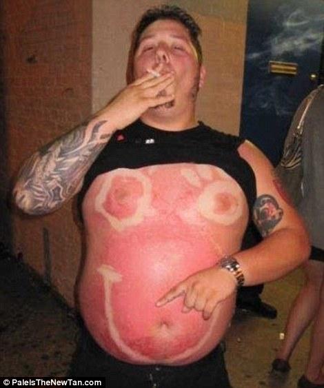 Крайне неудачный загар Смешной,неудачный, загар ,летом,от солнца