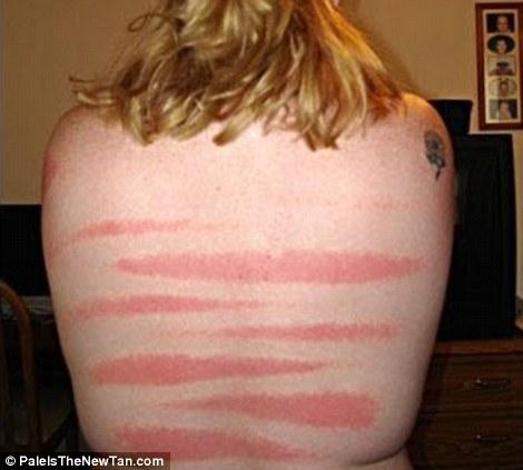 Крайне неудачный загар Смешной,неудачный, загар ,летом,от солнца