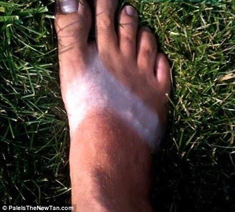 Крайне неудачный загар Смешной,неудачный, загар ,летом,от солнца