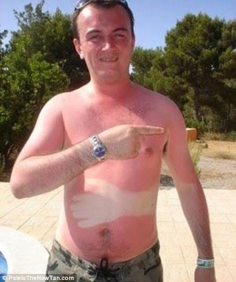 Крайне неудачный загар Смешной,неудачный, загар ,летом,от солнца
