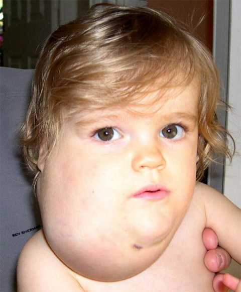 Несчастному ребёнку нельзя играть с детьми из-за болезни Лорен Купер, киста,болезнь