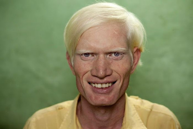 Желтый человек какая болезнь. Семья альбиносов. Семья альбиносов в Индии. Семья Пуллан. Индус альбинос.
