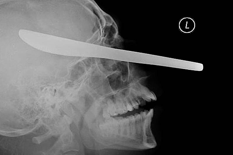 Рентгеновские снимки, рентген ужас, страшные рентгеновские снимки