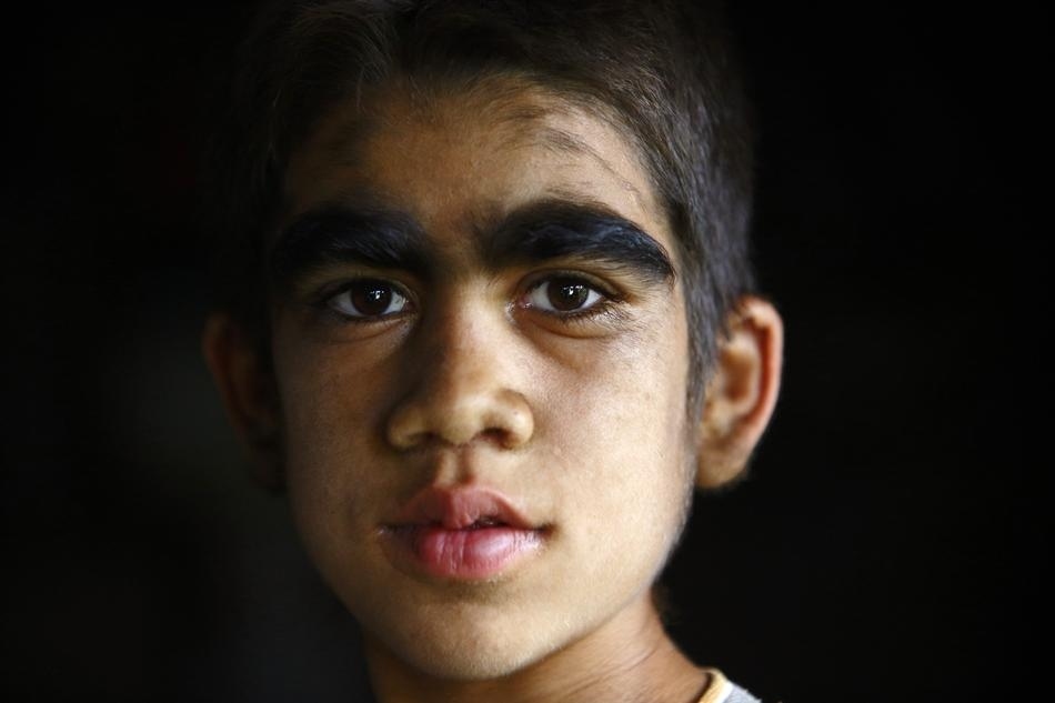 Семья с «синдромом оборотня» обрела человеческий облик «синдром оборотня», гипертрихоз, лазерная эпиляция