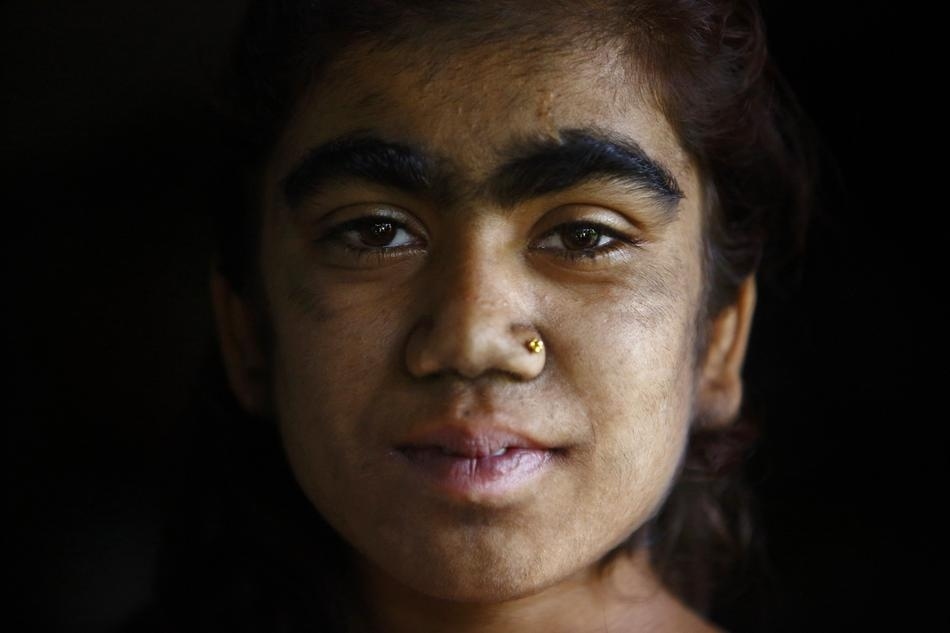 Семья с «синдромом оборотня» обрела человеческий облик «синдром оборотня», гипертрихоз, лазерная эпиляция