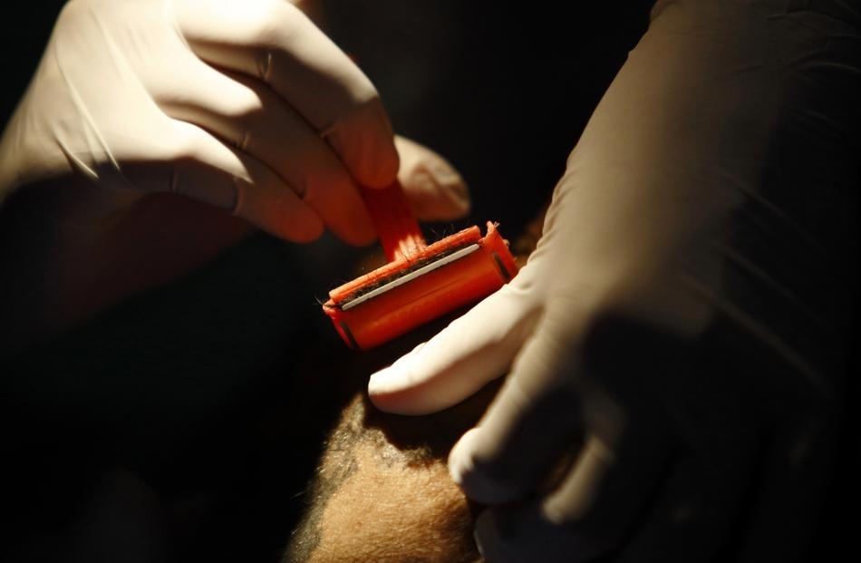 Семья с «синдромом оборотня» обрела человеческий облик «синдром оборотня», гипертрихоз, лазерная эпиляция