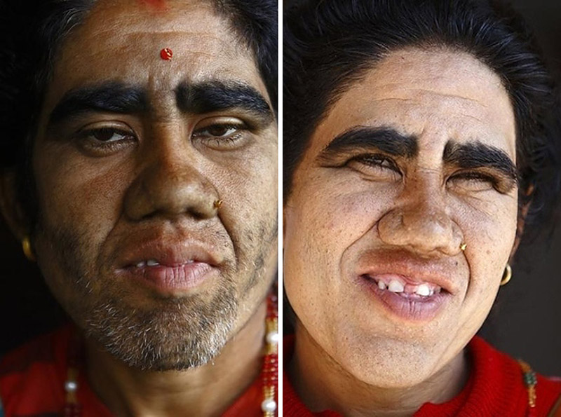 Семья с «синдромом оборотня» обрела человеческий облик «синдром оборотня», гипертрихоз, лазерная эпиляция