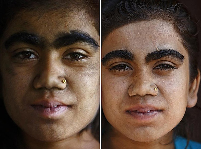 Семья с «синдромом оборотня» обрела человеческий облик «синдром оборотня», гипертрихоз, лазерная эпиляция