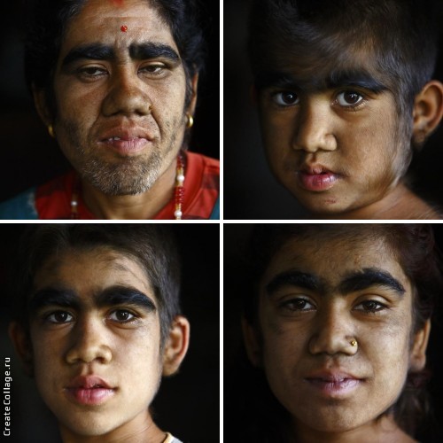 Семья с «синдромом оборотня» обрела человеческий облик «синдром оборотня», гипертрихоз, лазерная эпиляция