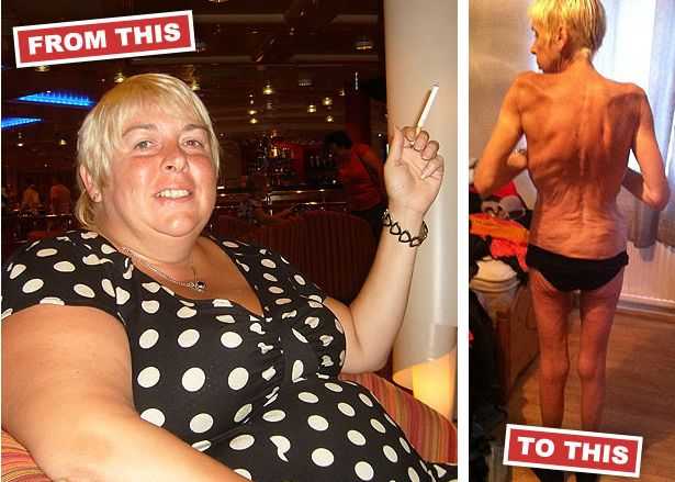 Операция превратила женщину в дистрофика операция, до и после, ожирение, анорексия