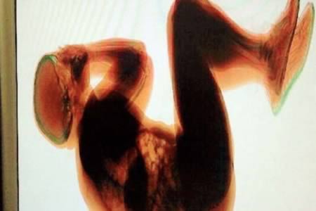 Истории самых ужасных последствий сильной пьянки Истории,последствия,алкоголь,пьянка