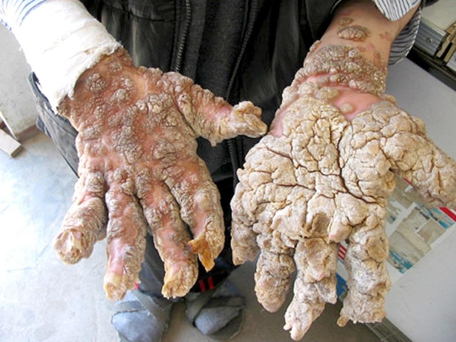 Жуткие человеческие болезни и мутации