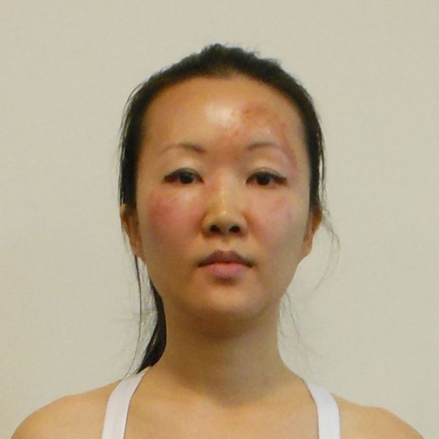 Чайна Чуу, chyna chuu, аллергия, самолечение, импетиго