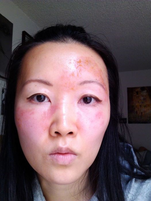 Чайна Чуу, chyna chuu, аллергия, самолечение, импетиго